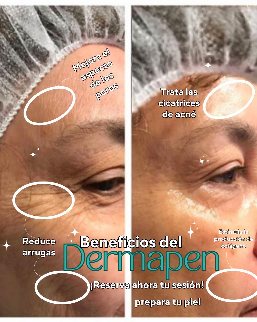 Descobreix el poder del Dermapen facial Rejoveneix la teva pell, redueix arrugues, marques d'acne i millora la textura amb aquest tractament revolucionari. Amb el Dermapen, la teva pell es veurà més llisa, fresca i radiant en poques sessions. 🌟 Regala’t una pell renovada i plena de vida! Reserva la teva cita avui mateix i experimenta els beneficis del Dermapen facial. 💆♀️💖 #Dermapen #Rejoveniment #NaturalBeauty Descobreix el poder del Dermapen facial
Rejoveneix la teva pell, redueix arrugues, marques d'acne i millora la textura amb aquest tractament revolucionari. Amb el Dermapen, la teva pell es veurà més llisa, fresca i radiant en poques sessions. 🌟
Regala’t una pell renovada i plena de vida! Reserva la teva cita avui mateix i experimenta els beneficis del Dermapen facial. 💆♀️💖 #Dermapen #Rejoveniment #NaturalBeauty