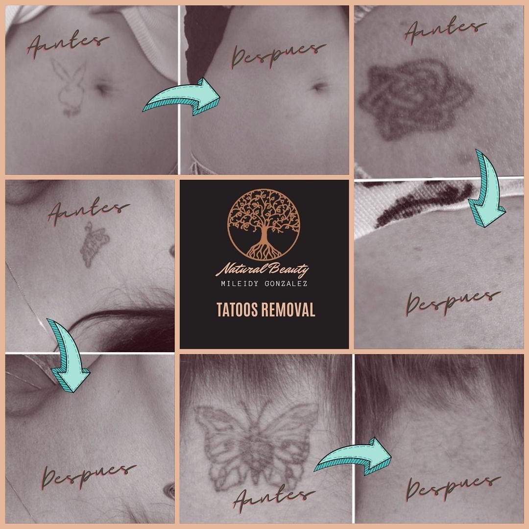 Què és l'eliminació de tatuatges amb làser, i que tan efectiva sol ser?

Truca'ns al 📲☎️624709/ 812666 i resoldrem tots els teus dubtes.

📍C/ Dr.vilanova 9 piso 1. Edificio Thais.

#naturalbeauty
#bellezanatural
#cuidarsenuncaasidotanfacil
#eliminatutatuaje
#eliminaciondetatuajes
#andorralovers
#andorratuestetica