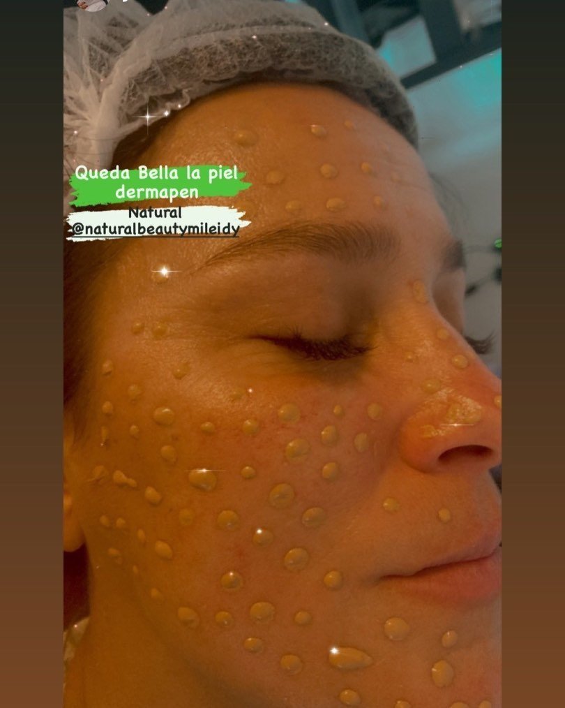 Beneficis del dermapen

Elimina les arrugues, marques, estries o cicatrius de diverses zones del cos. Millora l'aspecte de cicatrius i estries. Fomenta la creació de col·lagen i elastina de la pell. Millora les línies fines i arrugues. Beneficia la penetració profunda dels principis actius. Disminueix la mida dels porus.