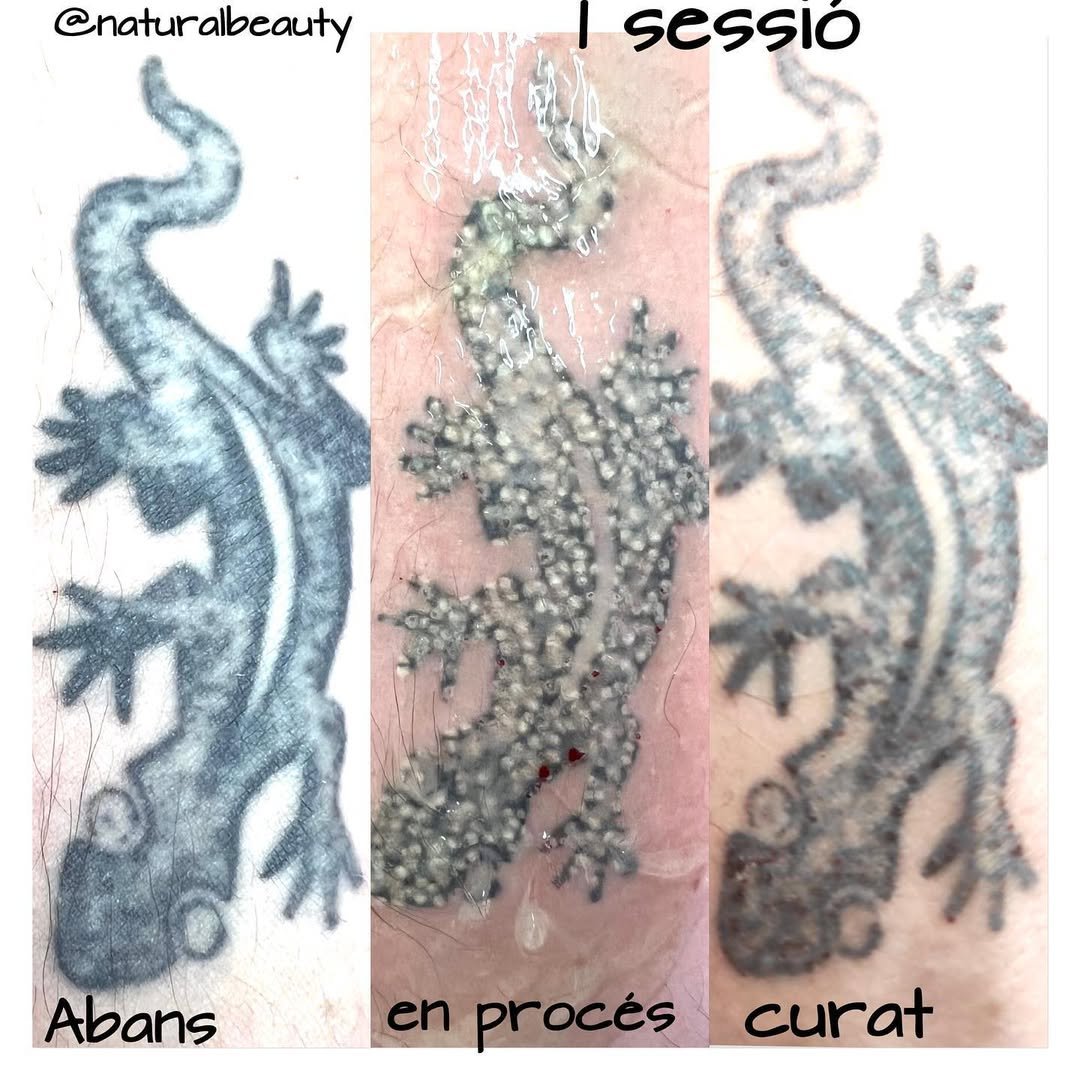 Resultat d'eliminació de tatuatge en una sessió.

#naturalbeauty
#bellezanatural
#cuidarsenuncafuetanfacil
#eliminaciondetatuajes
#eliminatutatto
#eliminaciontatuajesandorra
#tuestetica
#andorralovers
#tuesteticaybelleza