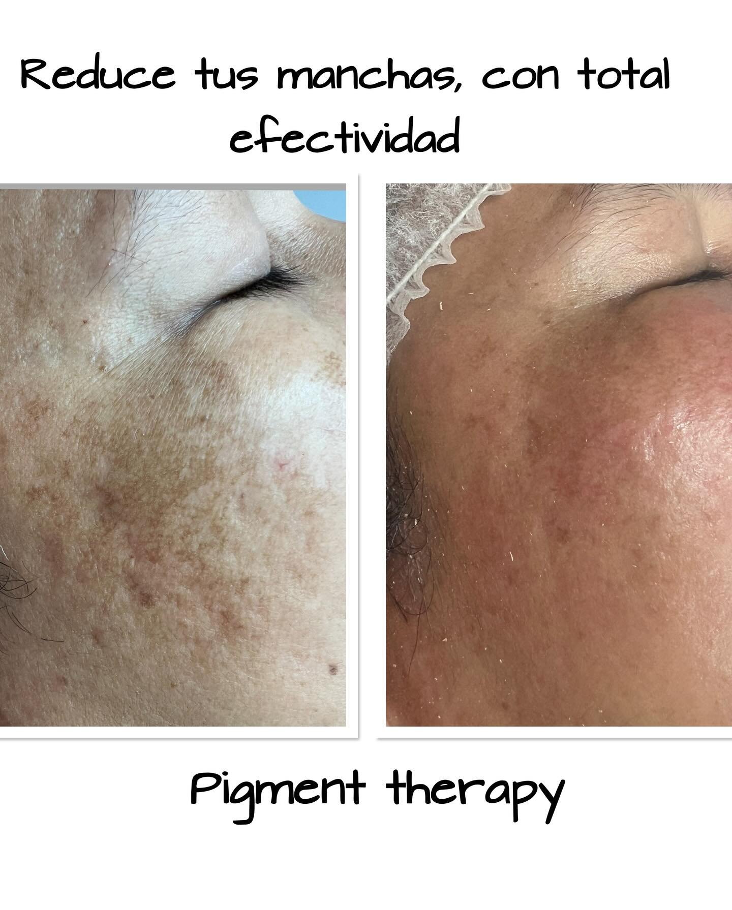 Aquí os dejamos un poquito el procedimiento del mesoboost y una demostración de sus visibles resultados. ✨ 👉🏼Si deseas más información sobre este o otro tatamiento ya sea facial o corporal. 📲☎️llámanos 812666/ 624709 📍visítanos en C/ Dr. Vilanova 9, primera planta, edifici Thaïs, Andorra la Vella. .. #naturalbeauty #bellezaycuidadopersonal #tuestetica #nosencantacuidardeti #cuidaturostro #siemprebella #mesoo #tratamientospersonalizados