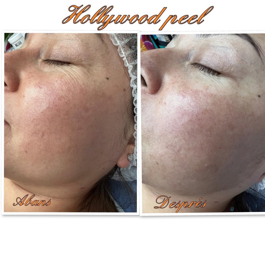 Quins beneficis podem obtenir amb el tractament de hollybook peel? ➡️ Primer fa un efecte d'exfoliació mitjana-profunda de la capa còrnia epidèrmica, així com una neteja i profunditat. ➡️ Tanca i minimitza el porus i per tant aconsegueix un efecte d'allisat i correctiu de les imperfeccions superficials de la dermis, porus, arrugues fines i marques de tota mena. ➡️ S'aconsegueix un rejoveniment global i millora visible de la pell. #naturalbeauty #bellezanatural #cuidarsenuncaasidotanfacil #hollybookpeel #rejuvenesimientofacial #carbonactivo #andorraestetica