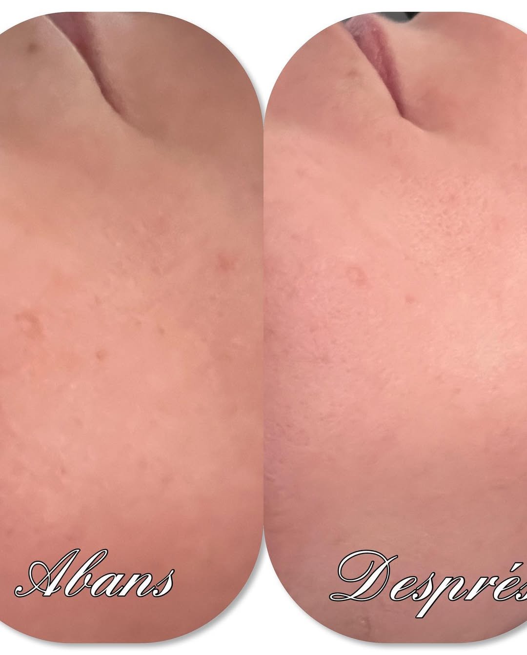 Què fa el Dermapen ? 🔷 És un procediment estètic molt efectiu per reduir les línies d'expressió, les arrugues o minimitzar marques d'acne, estries i cicatrius. 🔷 El tractament és apte per a qualsevol tipus de pell. Dermapen s'utilitza majoritàriament a la cara i escot. 🔷🔷 Beneficis de Dermapen 👉🏼 Millora la pell i elimina signes de l'edat com ara arrugues, taques i cicatrius. 👉🏼 Aconsegueix millorar la finor de la dermis gràcies a l'activació de col·lagen i elastina. 👉🏼 Lluiràs un rostre més lluminós, nodrit i hidratat. 👉🏼Reduiràs la flacciditat pròpia del pas del temps. #naturalbeauty #bellezanatural #Cuidaturostro #andorralover #tuestetica #nosencantacuidardeti #siempremasbellas #dermapen #dermapenfacial